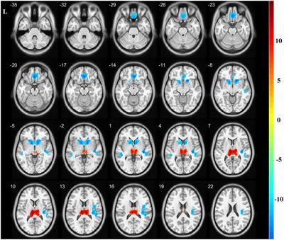 Structural and Functional Alterations in Hemodialysis Patients: A Voxel-Based Morphometry and Functional Connectivity Study